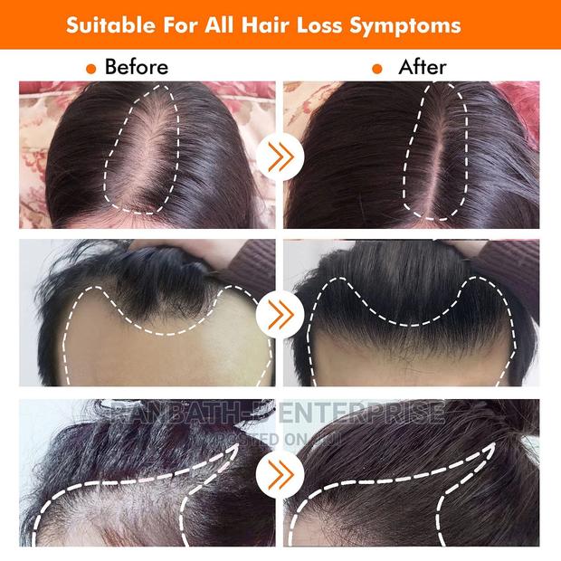 Derma Hair Roller System (0.5mm) · Photo 4