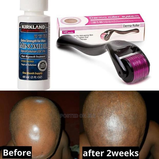 Kirkland Minoxidil and Derma Roller Combo for Hair Growth · Photo 2