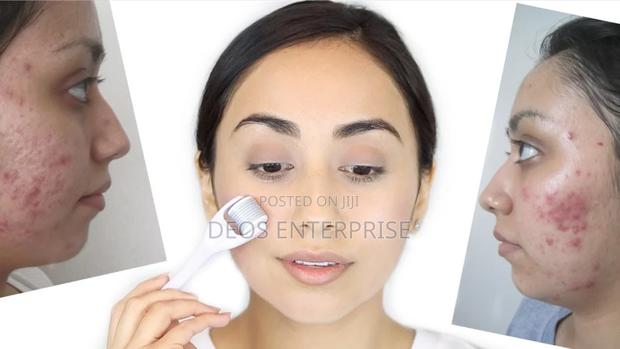 Derma Roller for Treating Scalps · Photo 2