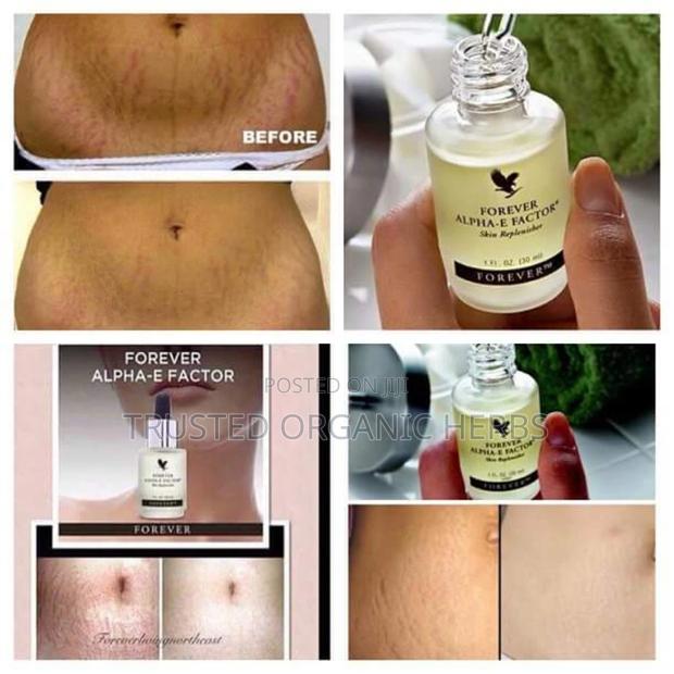 Best Stretch Marks Removal Products /Forever Living Products · Photo 2