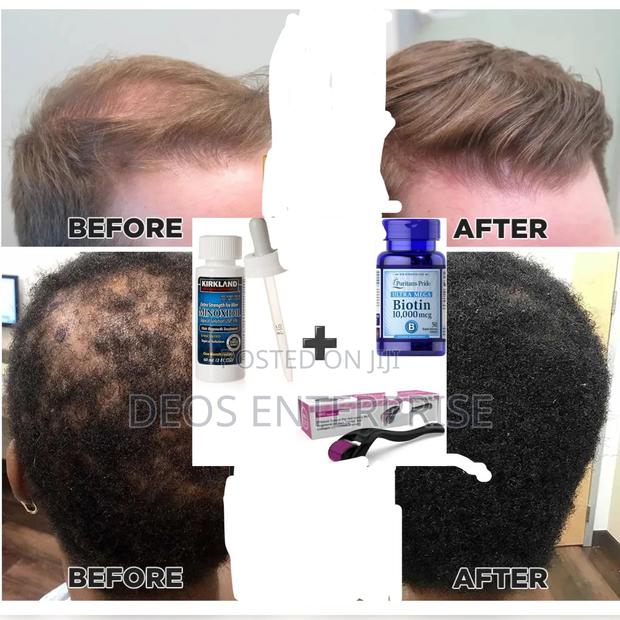 Recommended Super Combo for Beard and Hair Growth · Photo 2