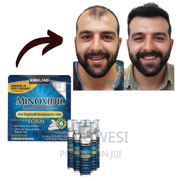 Kirkland Foam ( Hair Regrowth Treatment for Men · Photo 2