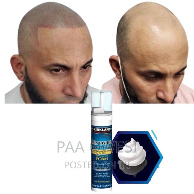 Super Fast Hairline Regrowth · Photo 2