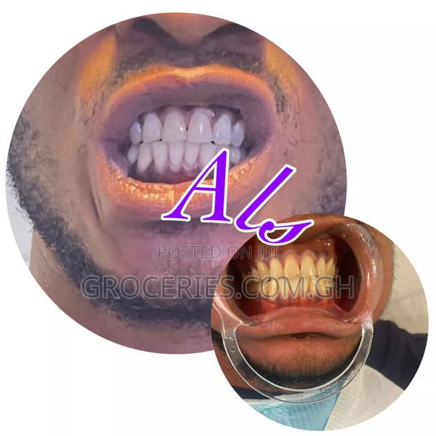 Laser Teeth Whitening · Photo 3
