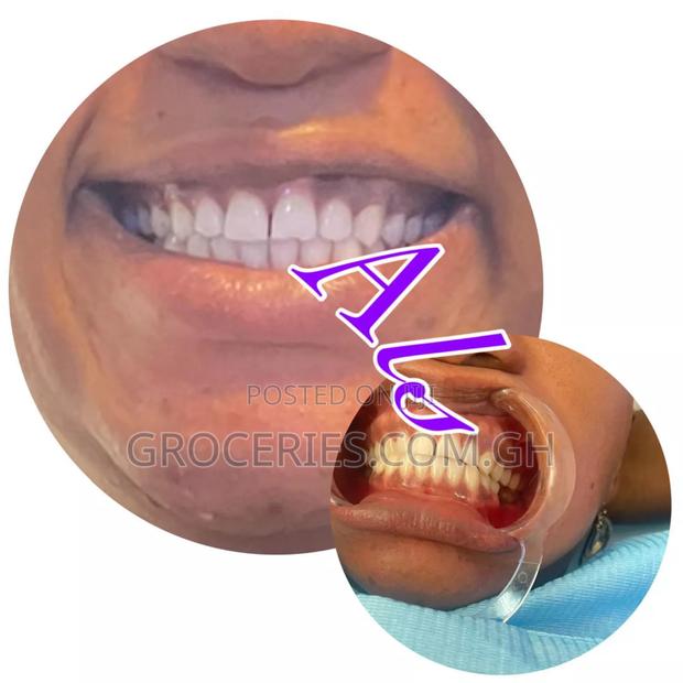 Laser Teeth Whitening · Photo 4