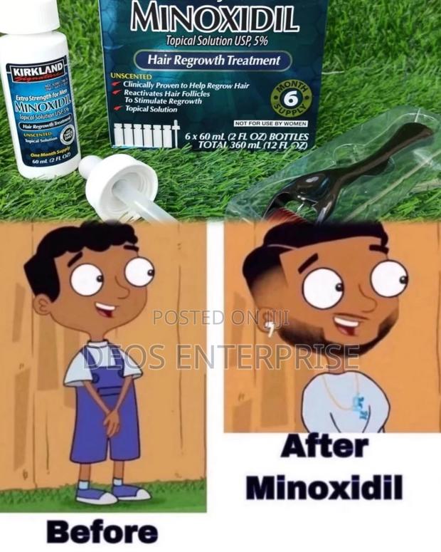 Kirkland Minoxidil Derma Roller Beard and Baldness Growth · Photo 2