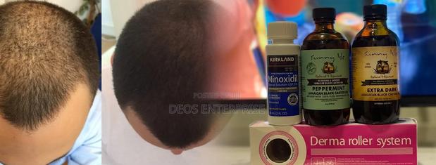 Great Product for Baldness Growth · Photo 2