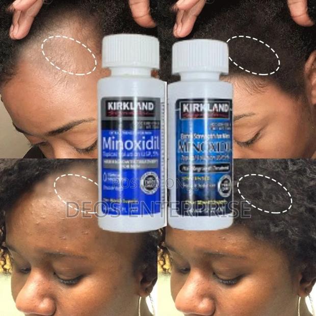 Two Kirkland Minoxidil for Hair Growth for Sale · Photo 2