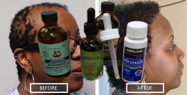 Affordable Quality Hair Loss Growth Products · Photo 2