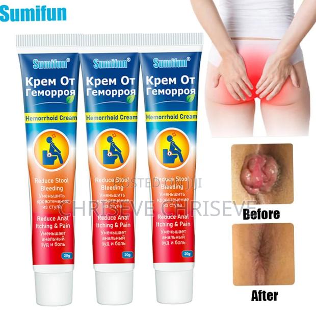 Hemorrhoids Cream