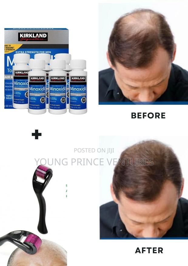 The Ultimate Hair Growth Solution