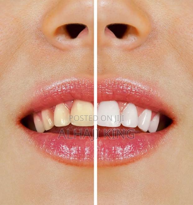 Complete Teeth Whitening Service