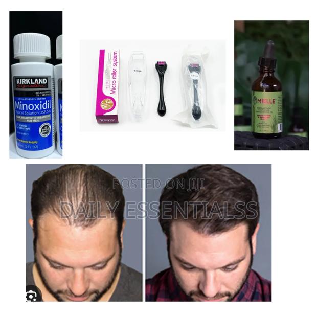 Bald Spots Patchy Beard Solution · Photo 2