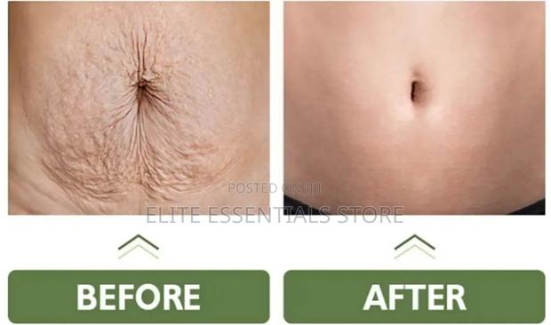 Tummy Tuck Stretch Marks Removal Skin Tightening Cream photo 2