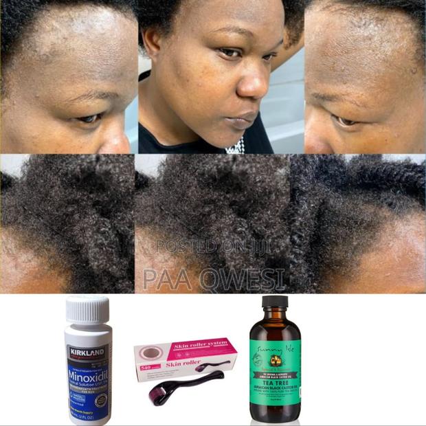 Effective Hair Growth- Use Sunny Isle Tea Tree W/Minoxidil · Photo 2
