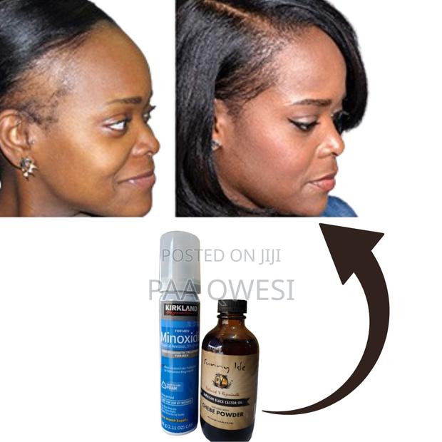 Kirkland Minoxidil Foam +Sunny Isle Chebe Powder · Photo 2