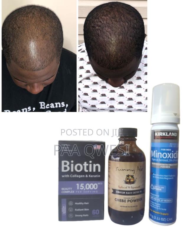 Biotin + Kirkland Foam+ Chebe Powder Oil Hair Growth Combo · Photo 2