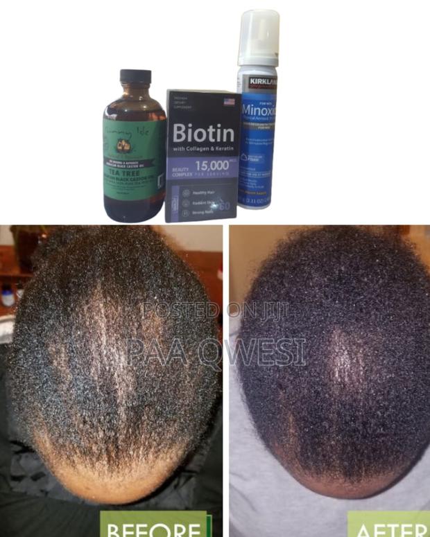 Stronger Hair Combo - Use Biotin + Kirkland Foam + Tea Tree · Photo 2
