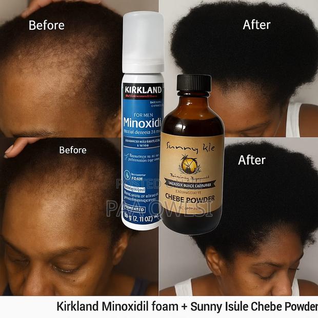 Chebe Powder + Kirkland Minoxidil Foam · Photo 2