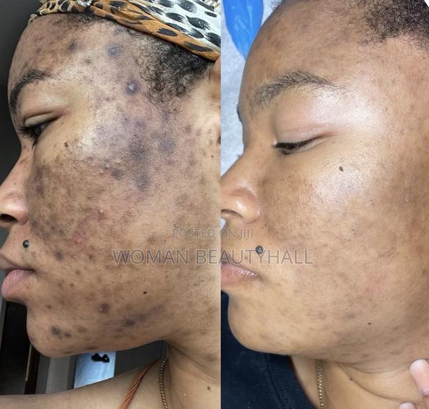 Dark Sports and Hyperpigmentation Treatment · Photo 2