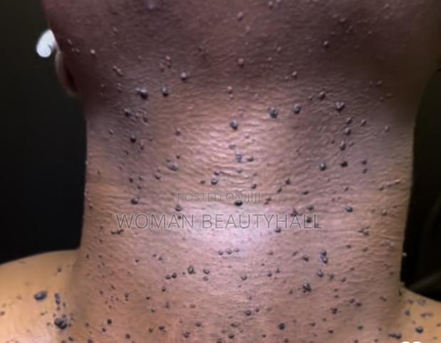 Skin Tag / DPN Removal · Photo 2