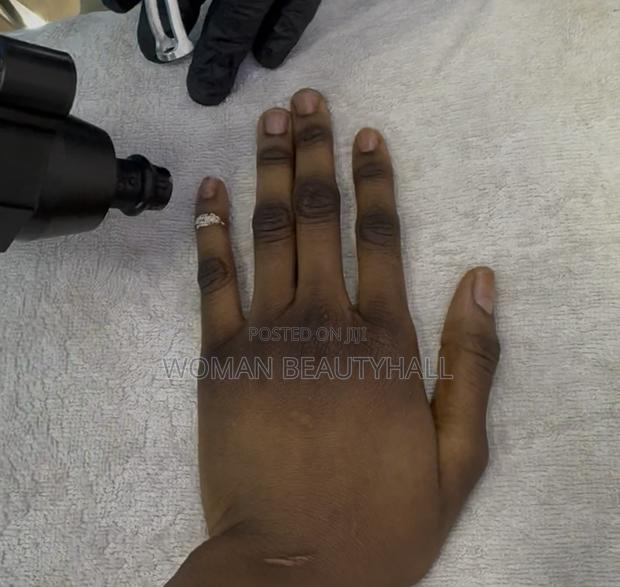 Dark Knuckles Laser Treatment · Photo 2