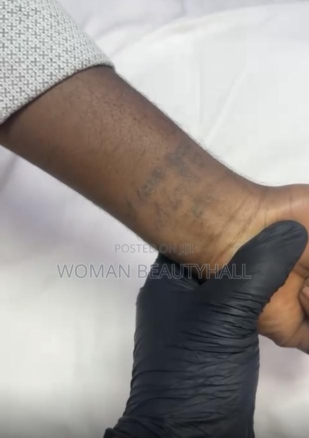 Tattoo Removal · Photo 4