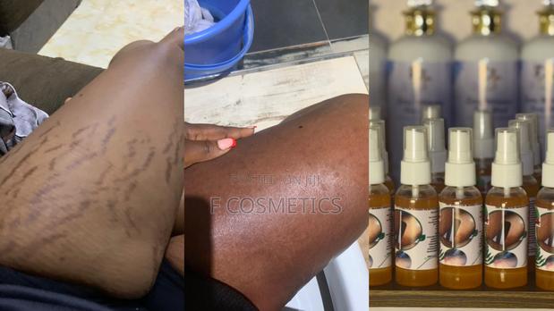 F8t Stretchmarks Removal Oil · Photo 1